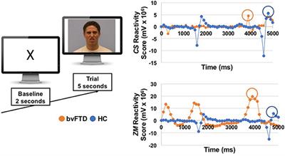 Enhanced Positive Emotional Reactivity Undermines Empathy in Behavioral Variant Frontotemporal Dementia